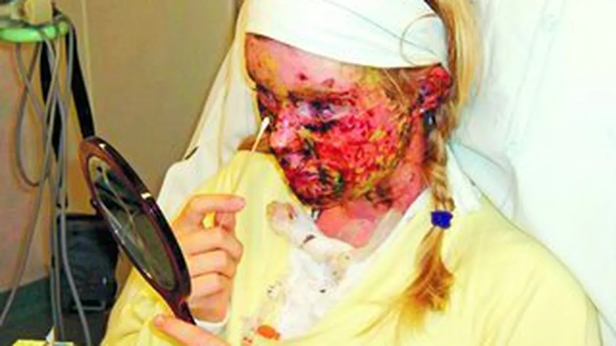 Desfigurata de paracetamol