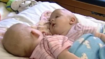 Acum 10 ani, doctorii au încercat să separe cele două siameze! Cum arată fetiţele acum 