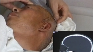 VIDEO Doctorii s-au prins ce nu e bine, dupa 23 de ani. Pacientul traia cu un glont in cap!