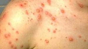 O fata de 11 ani bolnava de varicela a murit, dupa ce bunica ei a dat-o cu o solutie toxica crezand ca are raie