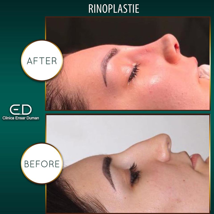Operația de rinoplastie în Turcia! De ce să alegi pachetele de turism medical când vrei să te operezi la nas