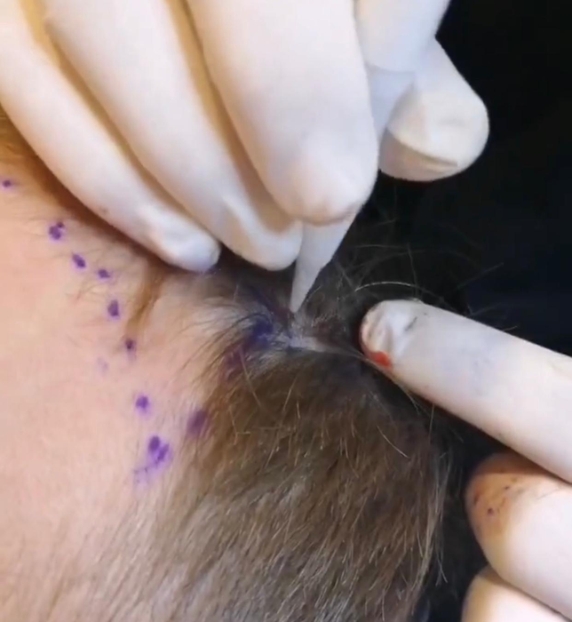 Legacy Med aduce în România inovație în transplantul de păr: implant de păr pentru femei fără a tunde podoaba capilară. Colaborare specială cu Turkey Hair Academy