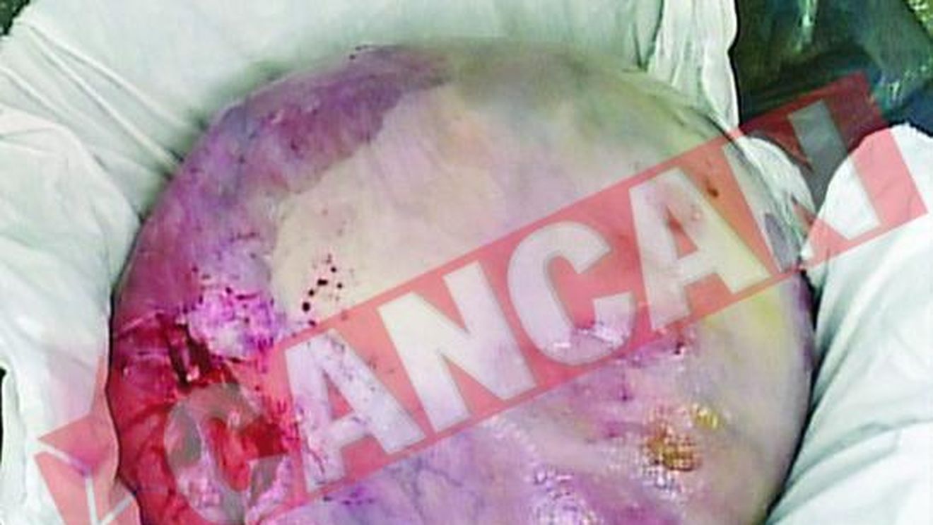 I-au scos o tumora de 15 kilograme din ovar