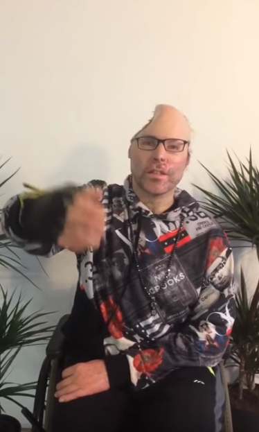 Rapper-ul Dr Knarf, paralizat și mutilat și pe viață. Primele imagini după ce medicii i-au îndepărtat jumătate din cap în urma exploziei produsă la un laborator de droguri