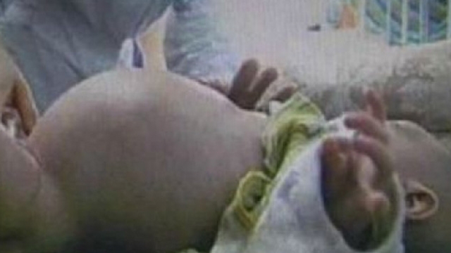 A uimit lumea medicală! Un băieţel de numai doi ani şi-a născut propriul FRATE! VIDEO IREAL