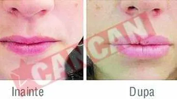 Totul despre marirea buzelor!