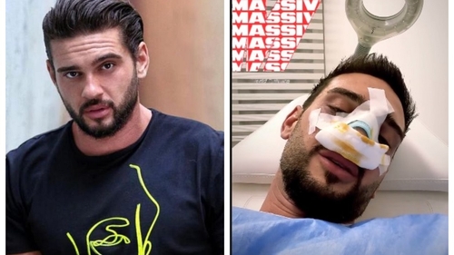 A zis că nu-și va opera nasul niciodată, dar s-a răzgândit! Cum arată Dorian „Hâtz” Popa, după ce și-a făcut rinoplastie