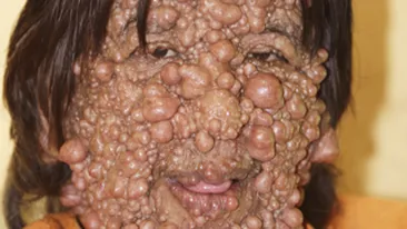 IMAGINI NERECOMANDATE PERSOANELOR SENSIBILE! Are fata si corpul pline de basici! Uite cum arata un indonezian afectat de sute de tumori!
