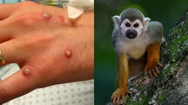 Variola maimuței se extinde în România! Încă trei cazuri au fost diagnosticate la noi în țară