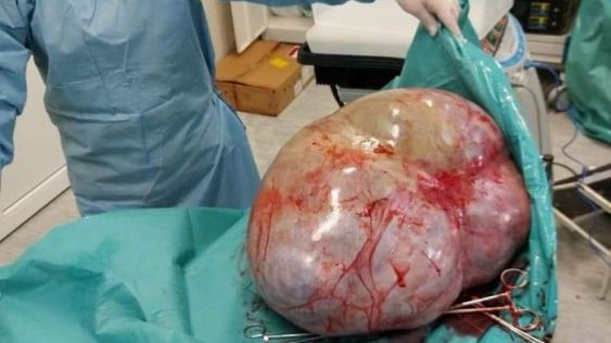 FOTO. Caz incredibil la Botoșani. Tumoare de 24 de kilograme, extirpată din abdomenul unei femei infectată cu COVID-19