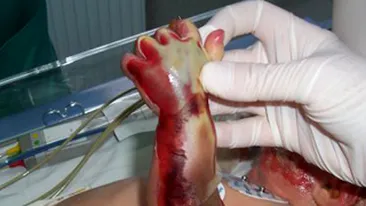 Un bebelus de 11 luni a fost transportat la spital cu arsuri grave pe corp!