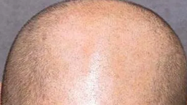 Cea mai tare inventie pentru barbati! Vezi cum poti sa scapi rapid de chelie si sa dai gata fetele!