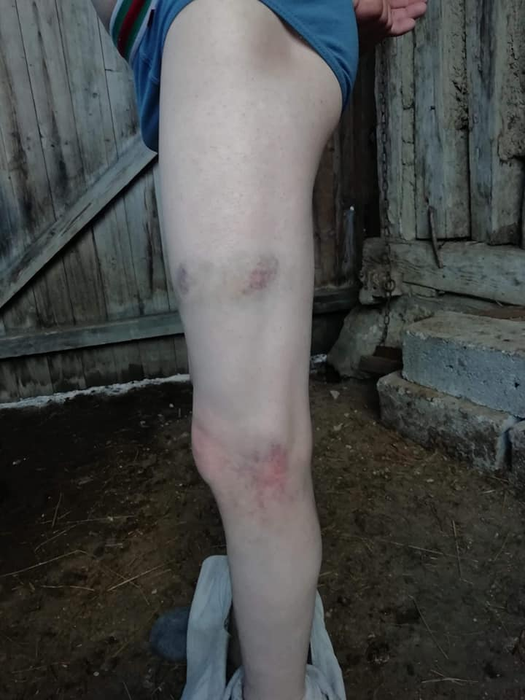 Urmele bătăii pe care tânărul ar fi primit-o la poliție
