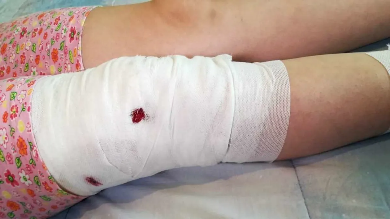 Fetiță de 10 ani din Mediaş, atacată de un câine maidanez. Copilul a fost mușcat de nas, mâini și picioare | VIDEO