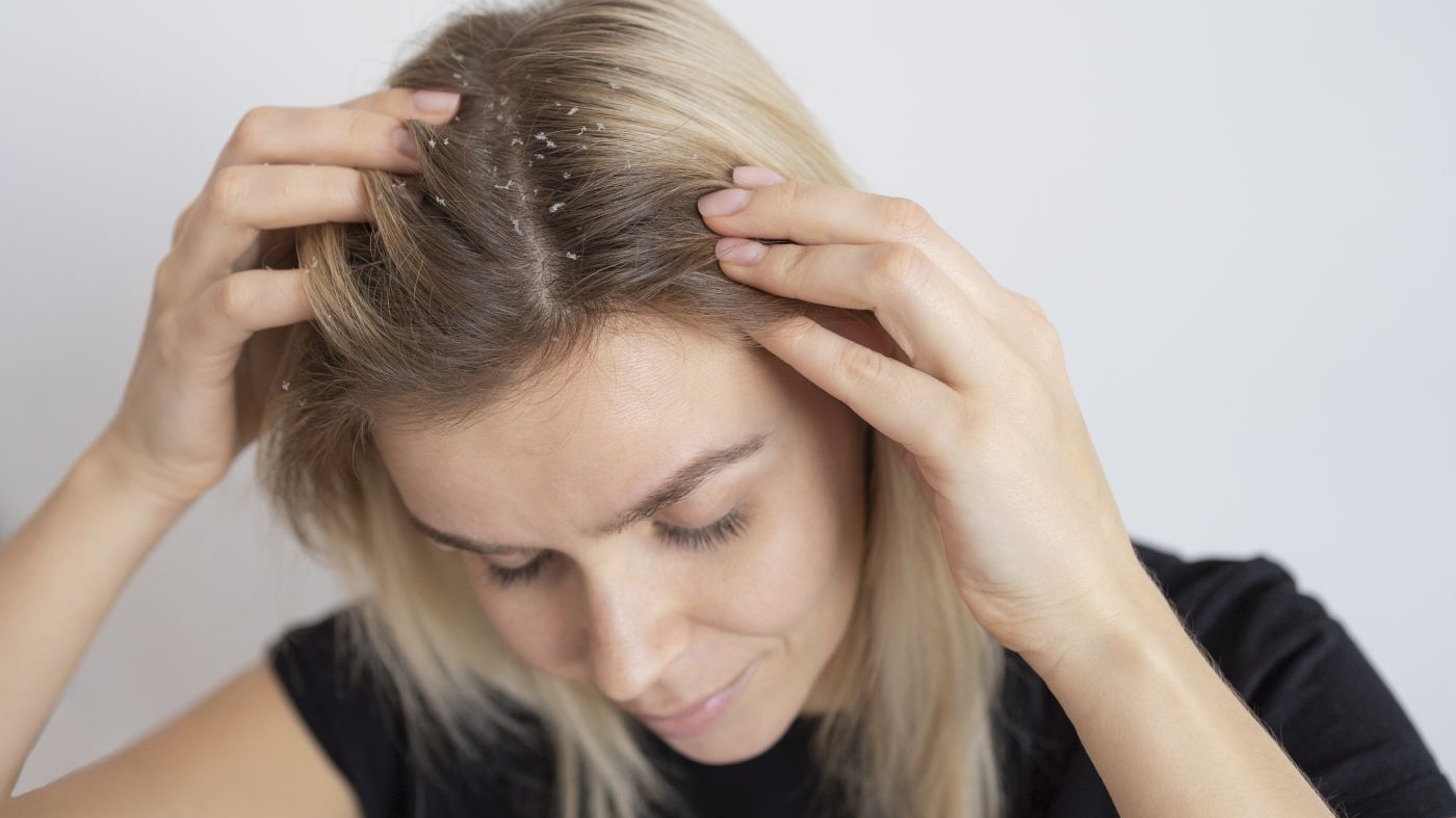 Când scalpul cere ajutor: dermatita seboreică și soluțiile naturale care pot calma pielea