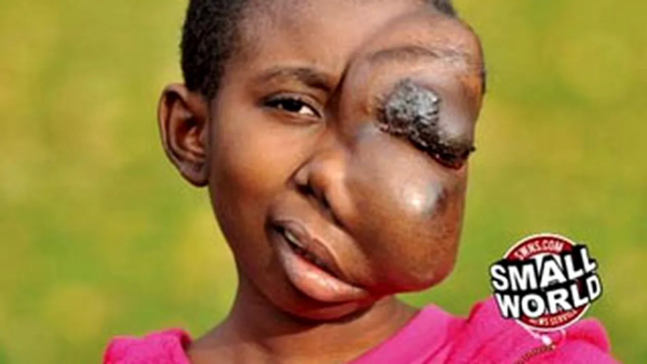 O fetita  cu o tumoare cat o minge de fotbal a fost operata cu succes
