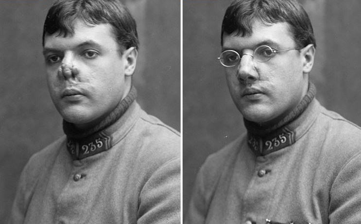 Imagini rare cu soldaţii din Primul Război Mondial! Transformarea incredibilă prin care treceau dacă erau desfiguraţi pe câmpul de luptă