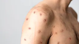 OMS, avertisment îngrijorător! Au fost raportate peste 600 de cazuri de variola maimuţei