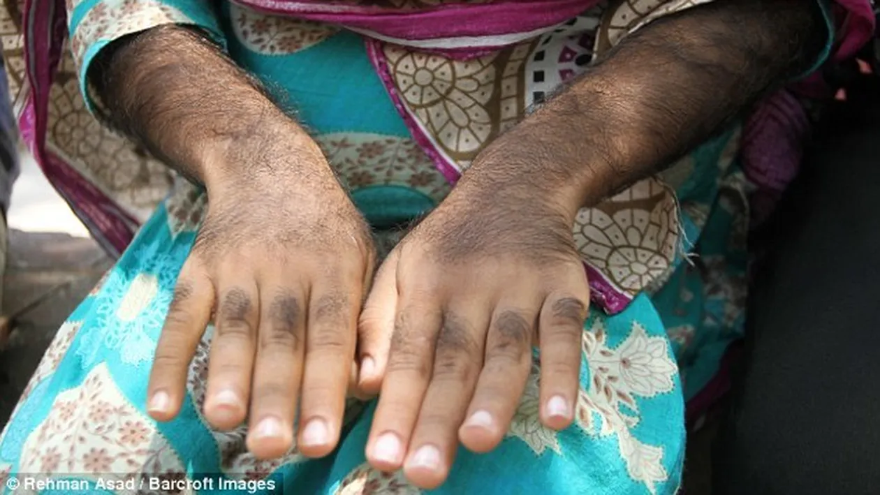 „Fetiţa-vârcolac“, cea mai mare ameninţare pentru un orăşel. FOTO cum arată copila acoperită cu „blană“ deasă 