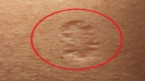 Ai și tu acest semn? Ce reprezintă, de fapt, cicatricea de pe partea superioară a brațului