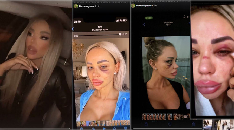 Bianca Drăgușanu a publicat mai multe poze după ce a fost snopită de Alex Bodi © Instagram Stories