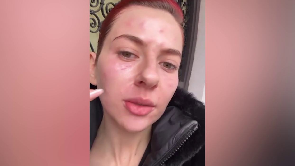Lidia Buble și-a speriat fanii! A apărut cu fața inflamată și amorțită: „Nu arată rău. Acum e cel mai umflat”