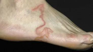 A crezut că are varice, dar în piciorul lui trăia un vierme! Află cum a scăpat! 