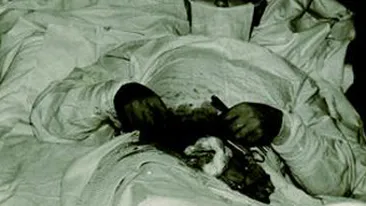 FOTO Si-a facut singur operatie de apendicita in 1961!