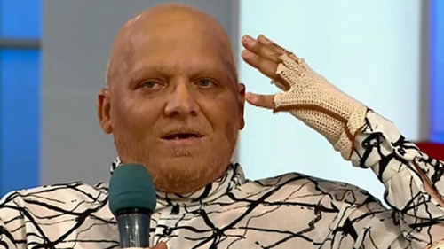Bolnav de cancer, Marian Darta e DISPERAT! Ce spune despre sedintele de chimioterapie pe care trebuie sa le faca!