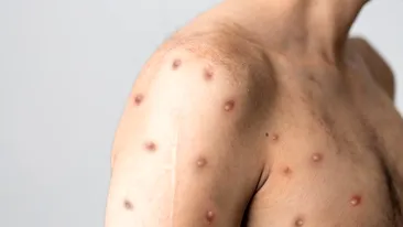 Un nou caz de variola maimuței, confirmat în România