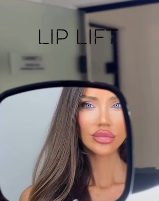 Cum arată Bianca Drăgușanu după intervenția de lip lift. A trecut aproape o lună de când și-a modificat buzele