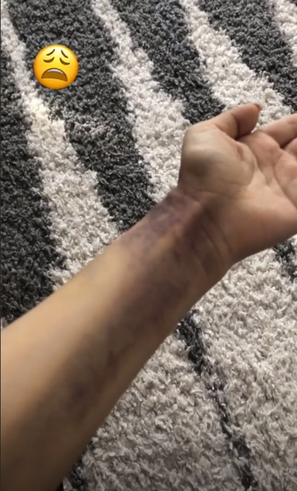 Andreea Bălan, plină de vânătăi. A răbufnit duminică dimineața la ora 10:16: „Aceasta este o poză facută la câteva ore după ce mi-am revenit din stopul cardio-respirator”