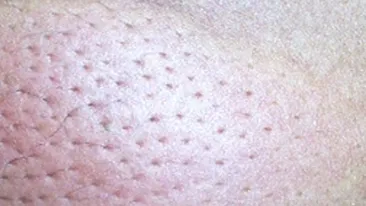 Cabral a fost intepat in burta de o viespe! Locul s-a tot umflat si ma mananca de ma sui pe pereti