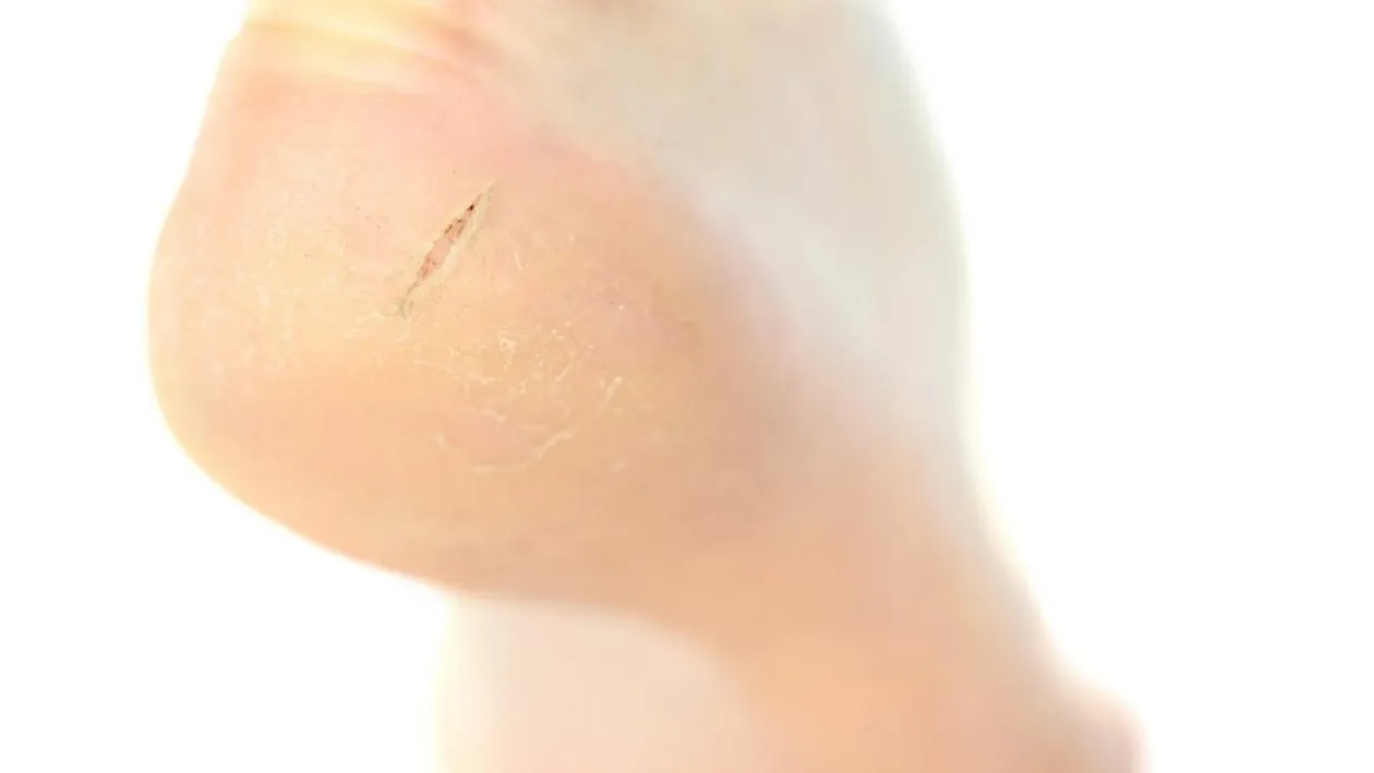 Călcâie crăpate? 5 remedii și vei uita de călcâiele crăpate și dureroase