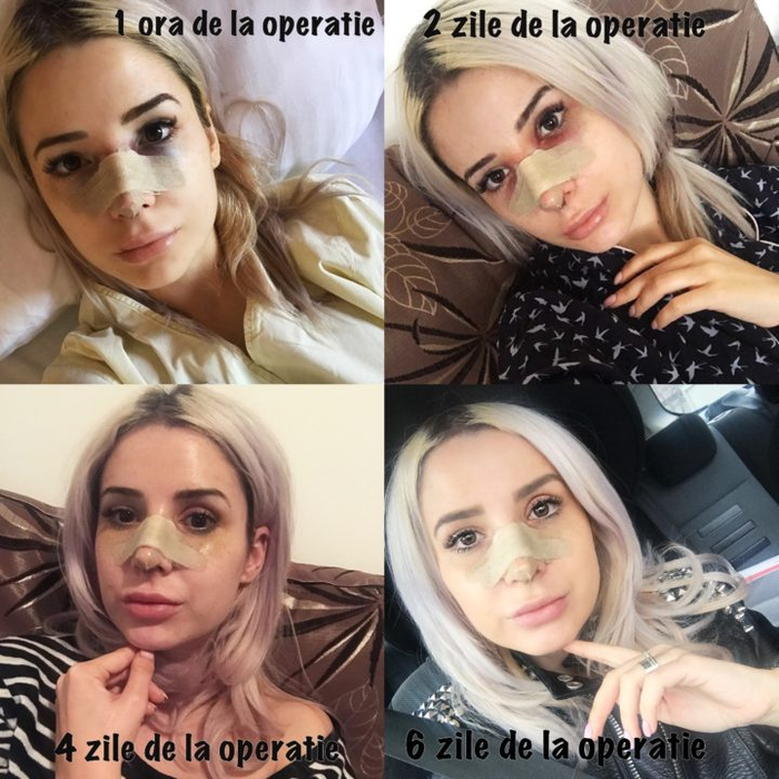 Deea și-a postat etapele vindecării în urma operației la nas