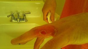 O sa ti se faca sila pentru ca nu ai vazut ceva mai dezgustator! Vezi ce ti se poate intampla si tie daca iti tratezi negii singur!