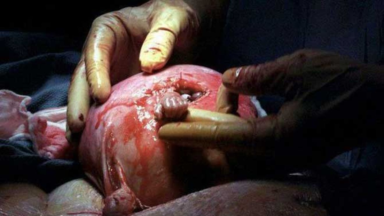 Povestea fotografiei care a impresionat o lume intreaga. Vezi ce mai face baietelul care a strans, din uterul mamei, mana doctorului