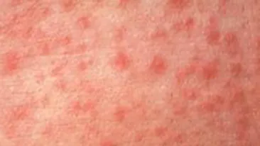 O fetita de 11 ani a murit de rujeola. Alti 5 copii sunt internati cu acelasi diagnostic