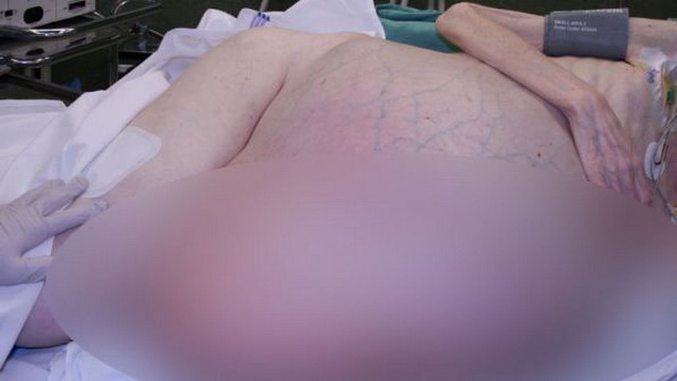 Ce ii crestea acestei femei in BURTA! Medicii au fost ingroziti cand au operat-o! "Cum se poate asa ceva?"