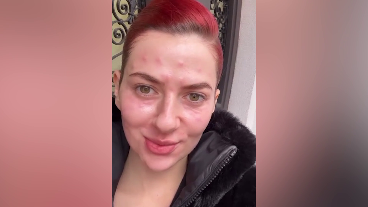 Lidia Buble și-a speriat fanii! A apărut cu fața inflamată și amorțită: „Nu arată rău. Acum e cel mai umflat”