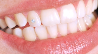 Totul despre bijuteriile dentare