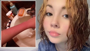 Ce este "urticaria acvagenă" - boala rarisimă cu care a fost diagnosticată această tânără. Este alergică la apă și la propriile-i lacrimi