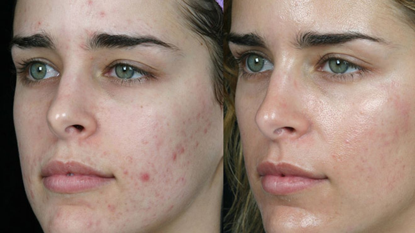 Andreea Ibacka foloseste un tratament antiacneic pe care-l prepara cu mai putin de 1 leu! Il poti realiza chiar la tine acasa