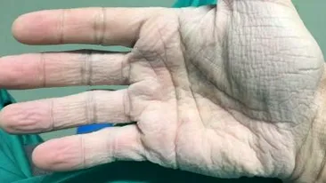 Emoţionant! Cum arată mâna unui chirurg din România, după 12 ore de muncă 