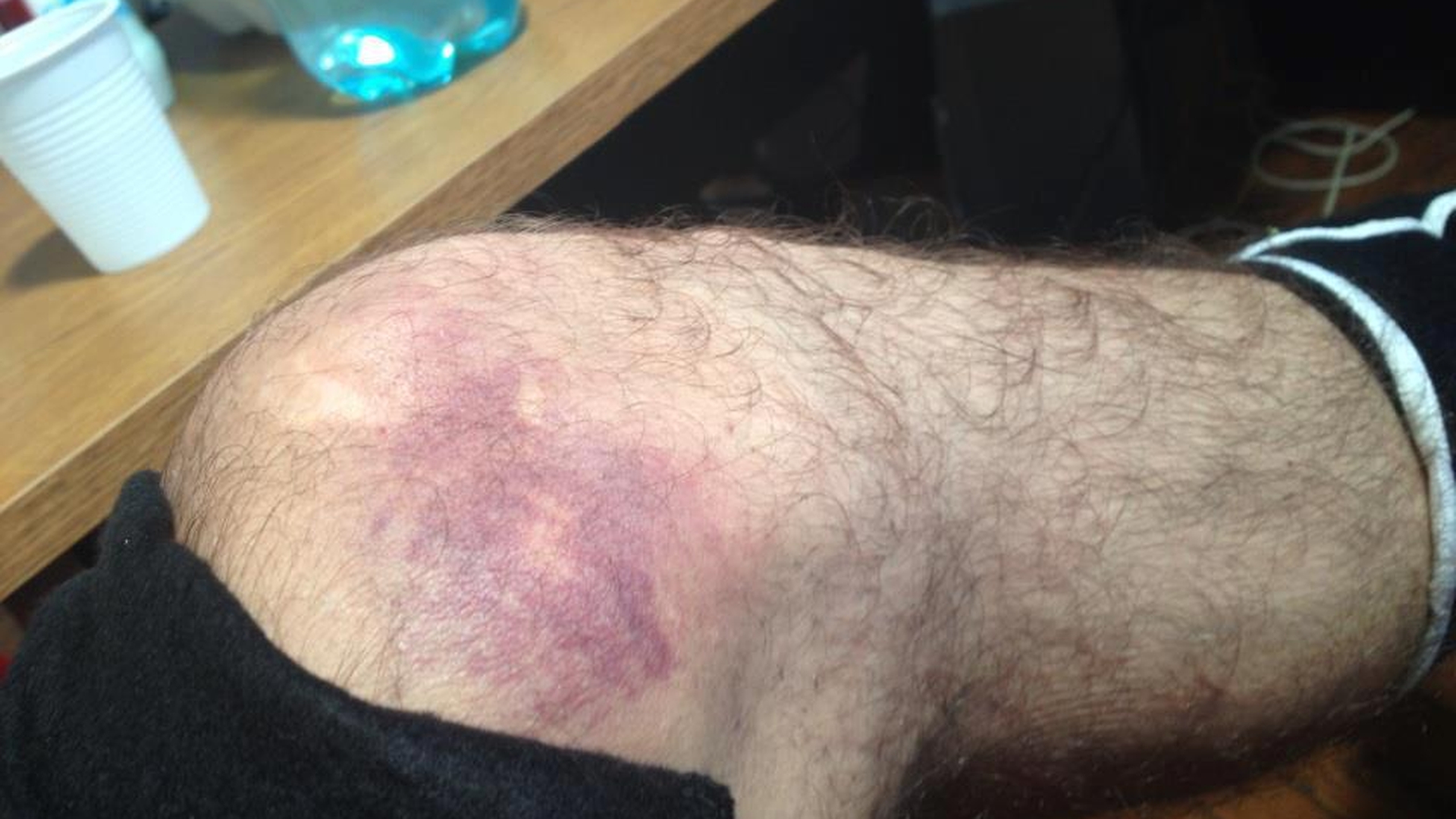 Serban, de la Animal X, s-a accidentat grav! Uite cu ce vanataie groaznica s-a ales in urma unui antrenament de la Dansez pentru tine!