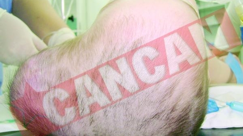 Un baietel de un an traia cu o tumora uriasa la cap
