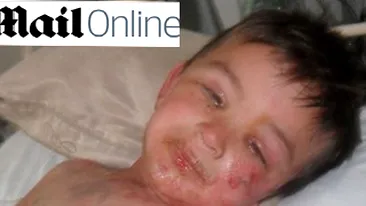 Un baietel de trei ani, la un pas de moarte din cauza unei reactii alergice la un analgezic foarte cunoscut