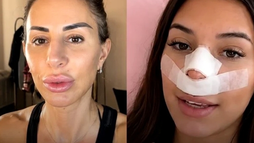 Val de reacții după ce o influenceriță s-a operat, pentru ca viitorii copii să nu îi moștenească nasul