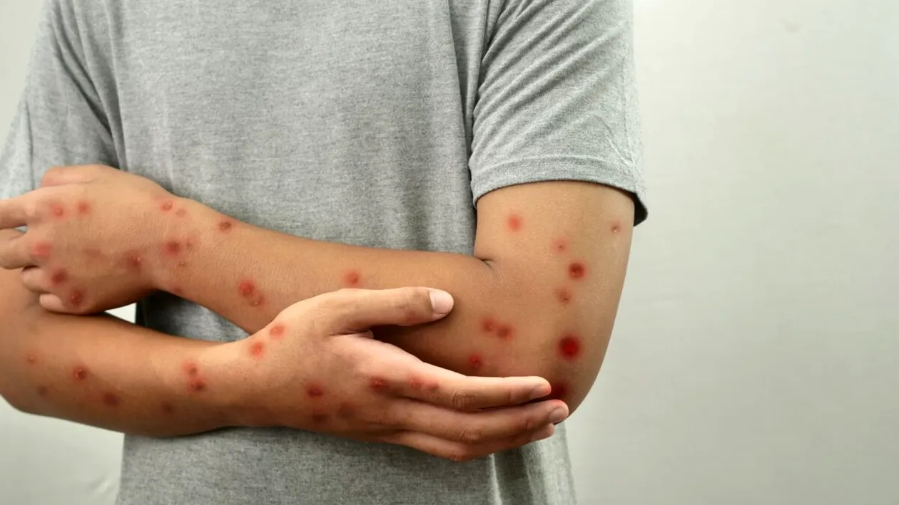 Ce este virusul mpox? A ajuns într-o țară din Europa în care locuiesc o mulțime de români