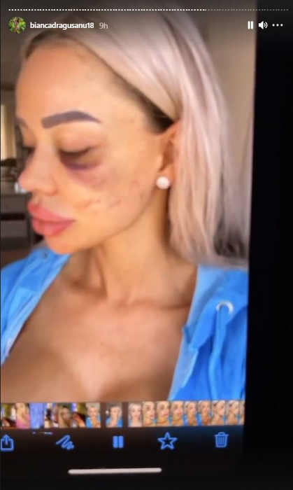 Bianca Drăgușanu a publicat mai multe imagini după ce a fost snopită de Alex Bodi: “Pentru pozele în care apar bătută, am depus o plângere penală” | FOTO